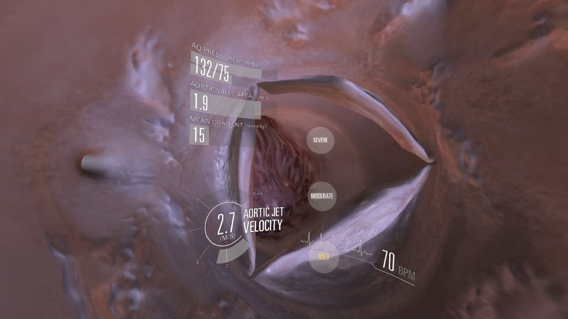 Virtual Value Virtual Reality VR Production Pipeline 3D VR heart valve with text graphic overlaid showing aortic pressure, aortic jet velocity - virtual reality in pharma
