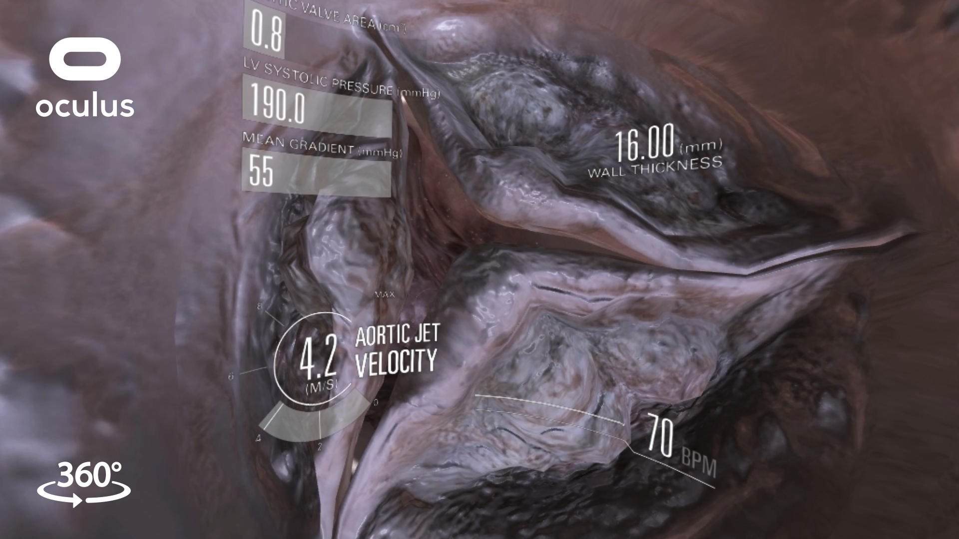 VR heart valve with graphics overlay displaying LV systolic pressure, aortic jet velocity and wall thickness