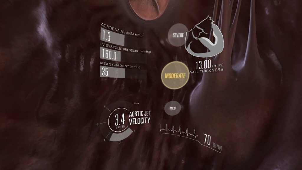 virtual-valve2 Virtual valve, 3D heart with text and graphic overlay showing systolic pressure, wall thickness, aortic jet velocity - Virtual Reality in Healthcare