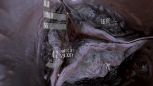 Virtual valve, 3D heart with text and graphic overlay showing systolic pressure, wall thickness, aortic jet velocity