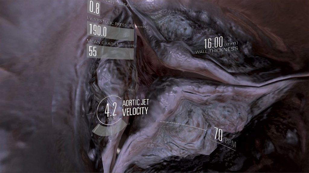 close up of virtual heart valve, medical virtual reality, graphic overlay for wall thickness, aortic jet velocity