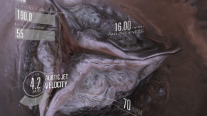 VR heart valve with graphics overlay displaying LV systolic pressure, aortic jet velocity and wall thickness