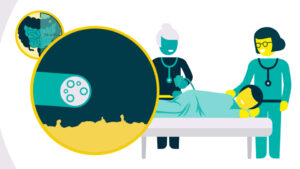 image of colonoscopy procedure for explainer animation