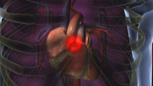 3D rendered image of a human heart inside a semi-transparent ribcage. The heart is shown with a red glowing area indicating a potential issue