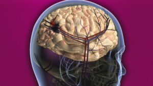3D rendered image of a human brain inside a semi-transparent skull, highlighting the vascular system. The brain shows a red area indicating a stroke with blood vessels prominently displayed. The background is a solid magenta colour