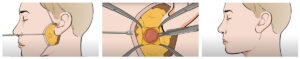 A still from a medical animation showing a surgical process