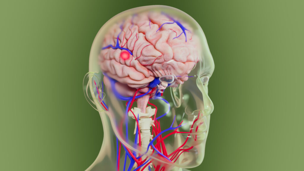 A detailed 3D medical illustration showing a transparent human head with the brain, blood vessels and spinal column visible inside. A glowing red highlight marks an area of interest within the brain, set against a soft green background.